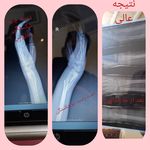 شکسته بندی محمد علی مختار