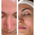 فیشیال و پاکسازی پوست ورسا