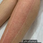 مون لیزر