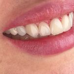 دندانپزشکی دکتر کاتبی کامپوزیت لمینیت