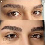 مرکز میکروبلیدینگ شیدینگ ریموو اسکالپ