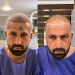 کاشت تخصصی مو،ابرو و ریش هاشمیان