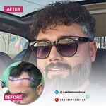 مرکز کاشت مو حسینی