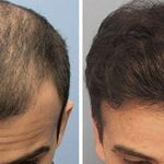 درمان تخصصی ریش و مو