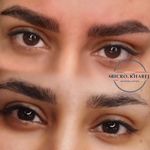 خدمات تخصصی میکرو بلیدینگ و ریموو خارج