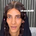 تزریق بوتاکس و ژل کانتور کامل صورت نصری