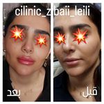 تزریق بوتاکس و ژل کانتور کامل صورت نصری