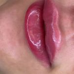کلینیک هانیل | فیلر بوتاکس آنی‌لیفت شرق