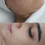 فیشال و پاکسازی تخصصی پوست سولماز