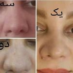 فیشال و پاکسازی. هایفو.پلاسماتراپی زهره
