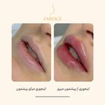 کلینیک تزریق فیلر و بوتاکس زرفیس