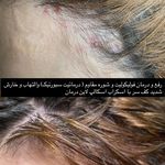 موسسه آموزش و درمان انواع ریزش مو ریشه