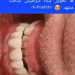دندانپزشکی ایمپلنت و کلیه خدمات