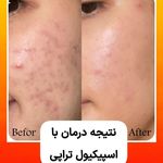 فیشال و پاکسازی پوست کارن
