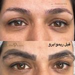 کلینیک تخصصی فاطمه وکیلی/ میکروبلیدینگ