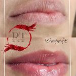 مرکز میکروبلیدینگ شیدینگ ریموو اسکالپ