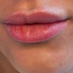 کلینیک هانیل | فیلر بوتاکس آنی‌لیفت شرق