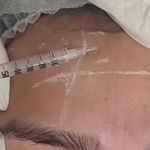 کلینیک هانیل | فیلر بوتاکس آنی‌لیفت شرق