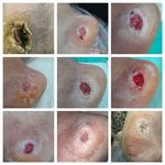 کارشناس زخم و متخصص کیوم تراپی بهرامی فر