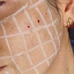 کلینیک هانیل | فیلر و بوتاکس شرق