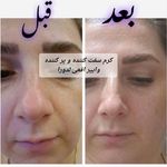 فشیال و پاکسازی پوست یعقوبی