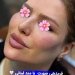 خانه لیزر فیلر و بوتاکس ثنا