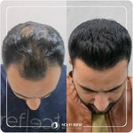 کلینیک کاشت مو نوین ایرانا