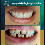 دکتر دندانپزشک ندا حیدری (متخصص لمینیت)