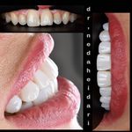 دکتر دندانپزشک ندا حیدری (متخصص لمینت)
