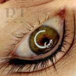 مرکز میکروبلیدینگ، شیدینگ، اسکالپ، ریموو