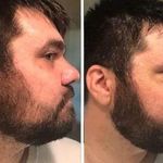 درمان تخصصی ریش و مو