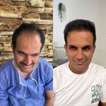 کاشت مو سحر کارگر