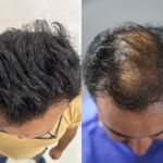 کلینیک کاشت مو ماهتیسا
