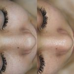 پاکسازی پوست،فشیال تخصصی در رودسر