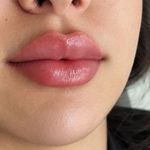 کلینیک هانیل | فیلر و بوتاکس شرق