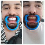 کامپوزیت لایرینگ و دندانسازی دکتر صفری