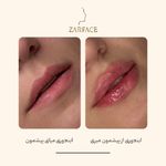 کلینیک تزریق فیلر و بوتاکس زرفیس