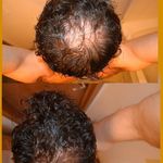 درمان تخصصی ریش و مو