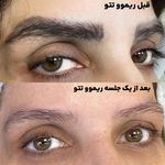 خدمات تخصصی ریموو  تتوی قدیمی