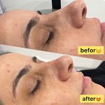 فیشال و پاکسازی پوست | رویا صالحی