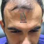 کاشت مو سمیه فلاح