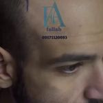 کاشت مو سمیه فلاح