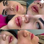مرکز لیزر ، ژل ، فیلر  بوتاکس کلینیک بلا
