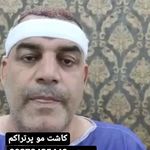 مرکز تخصصی کاشت مو محمدی