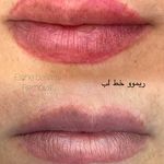 کلینیک تخصصی حذف تاتو