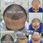 کاشت مو تخصصی سحر تلوری