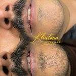 درمان تیرگی لب به روش دارک لیپس
