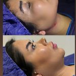 کلینیک زیبایی بوکال فت و سوپرکانتورغبغب