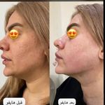 مرکز تخصصی لیزر موهای زائد و هایفو  فوبه