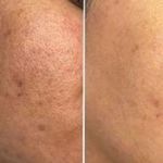 فشیال و پاکسازی تخصصی پوست